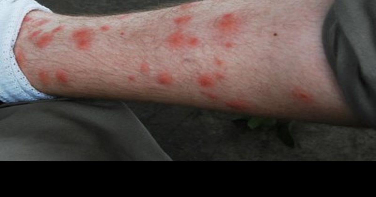 The trouble with chiggers Local News