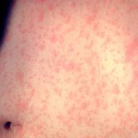 Measles Rash - CDC photo