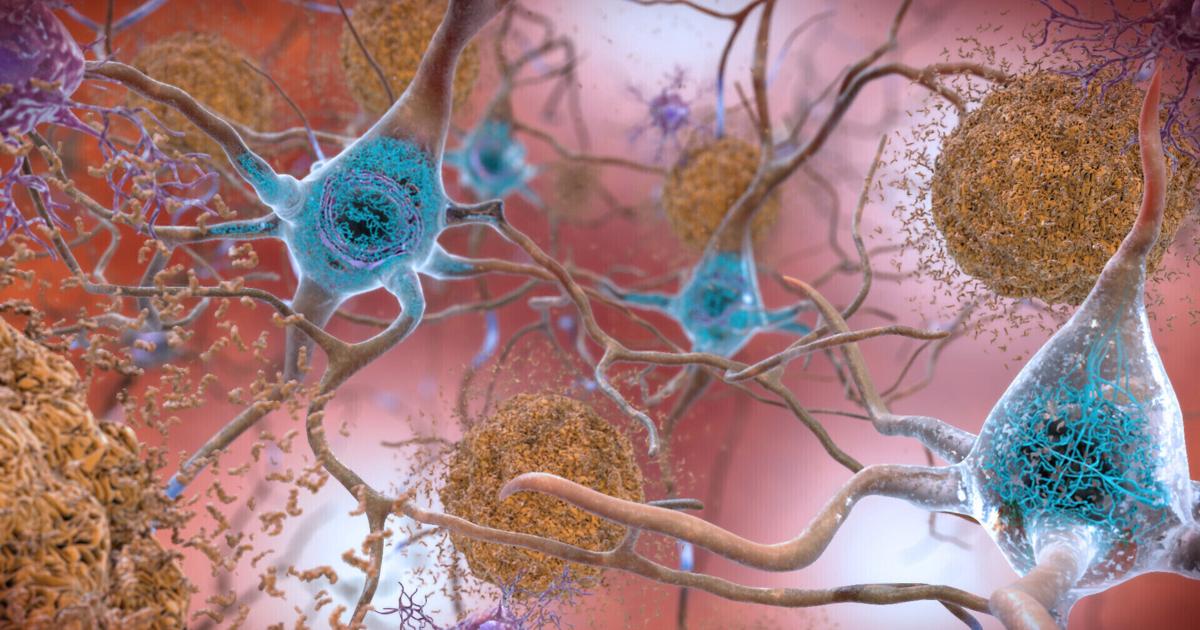 Promising drug slows Alzheimer's, but can it make a real difference?