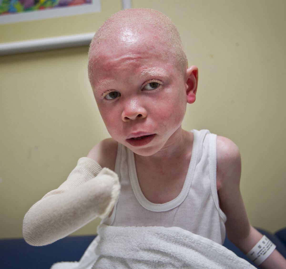 albino children maimed in tanzania now healing in u s
