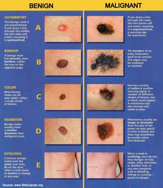 Not All Skin Changes Mean Cancer Health Paysonroundup