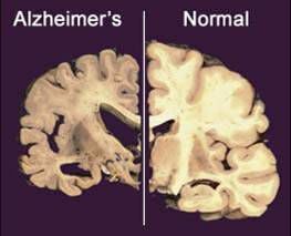 Alzheimer's Drug