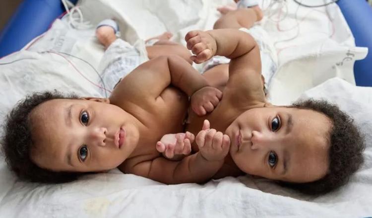 CHOP surgeons successfully separate conjoined twin boys after 8-hour ...