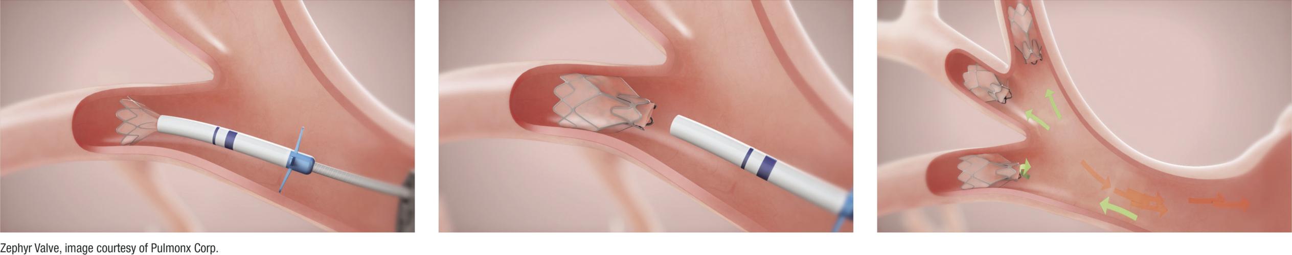 New lung surgery and treatment saves Coolidge woman's life Health And