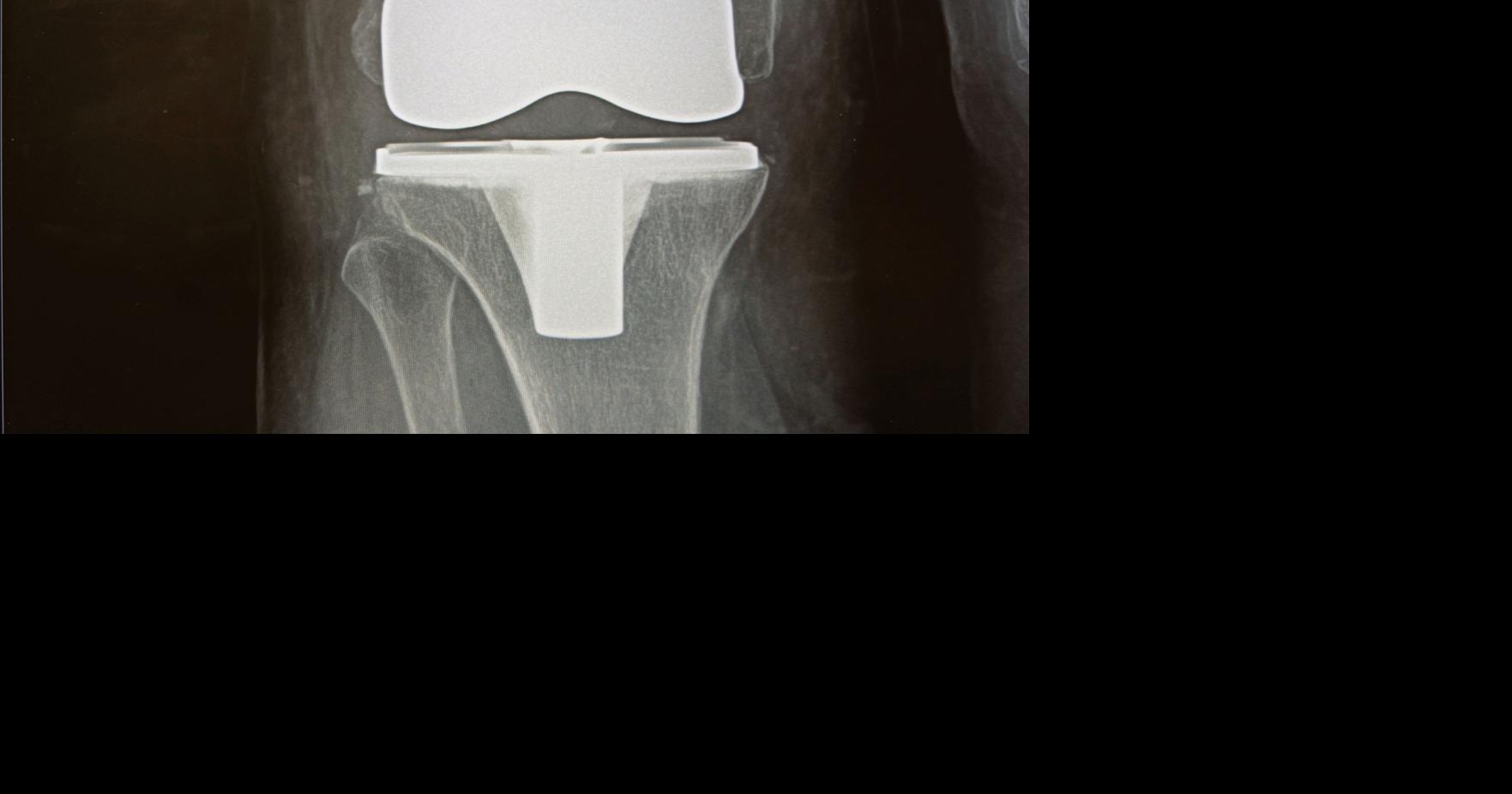 When good joints go bad Orthopedic joint replacement surgeries on the rise