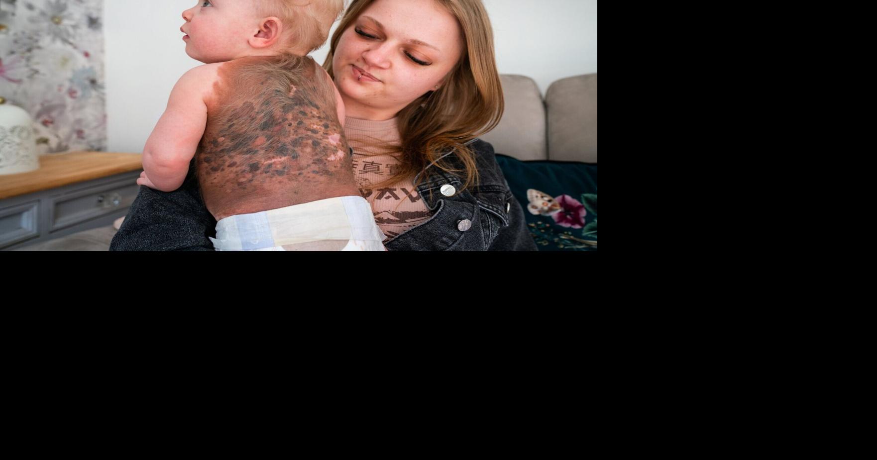 Family finds out baby’s ultra-rare birthmark is cancerous