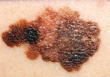 Skin cancer: the signs and how to prevent it