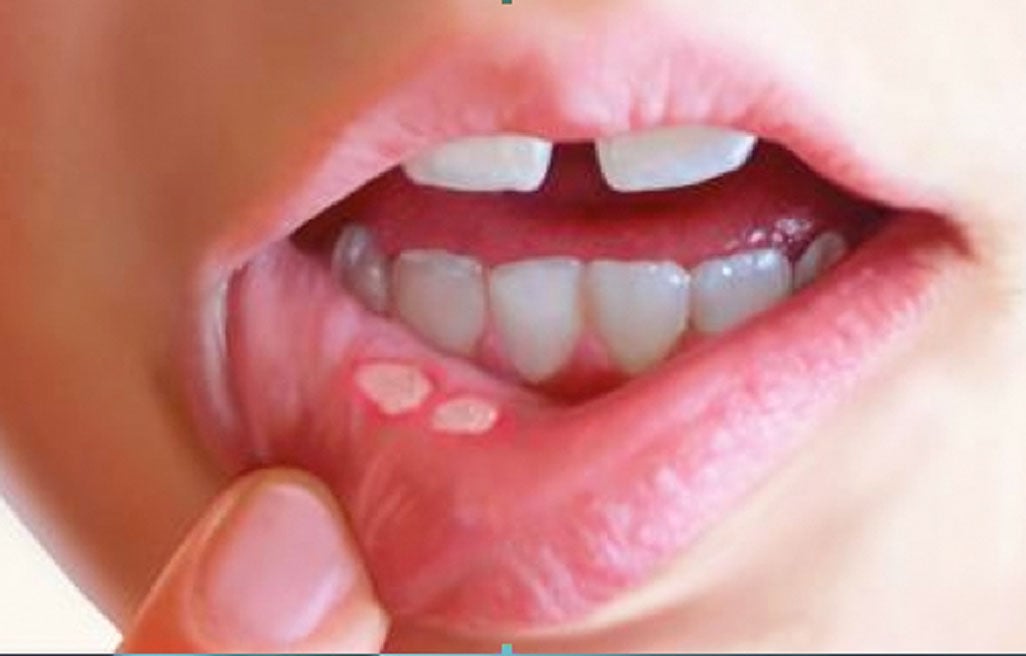 What are canker sores?