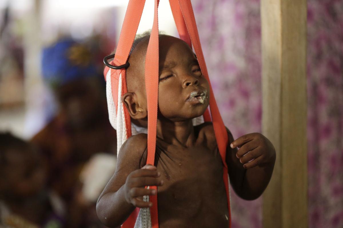 APTOPIX Nigeria Starving Children