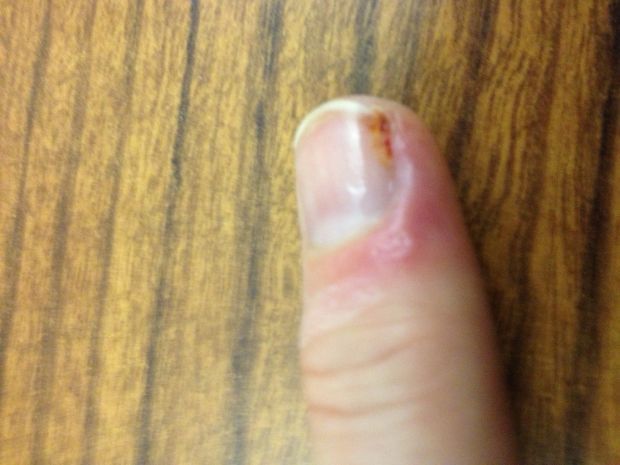 Side Of Fingernail Hurts And Green