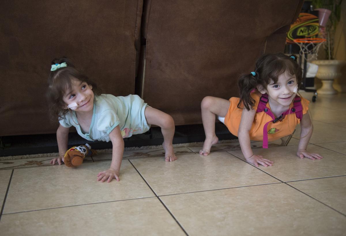 Separate Lives Formerly Conjoined Twins Discover Independence 7 Months After Risky Surgery Lifestyles Rapidcityjournal Com Separate Lives Formerly Conjoined Twins Discover Independence 7 Months After Risky Surgery Lifestyles Rapidcityjournal Com