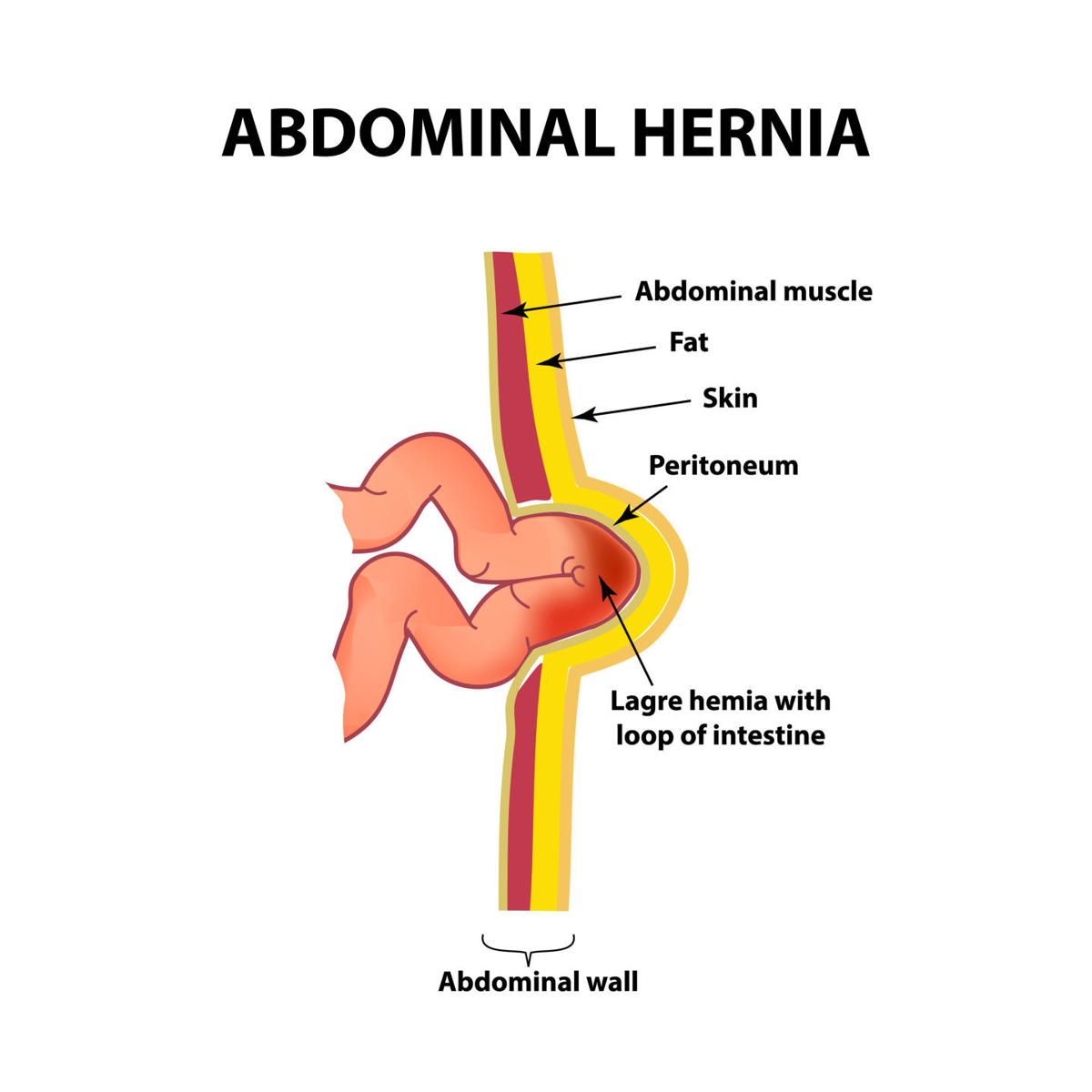 About Medicine The Inside Story On Hernias Health And Fitness