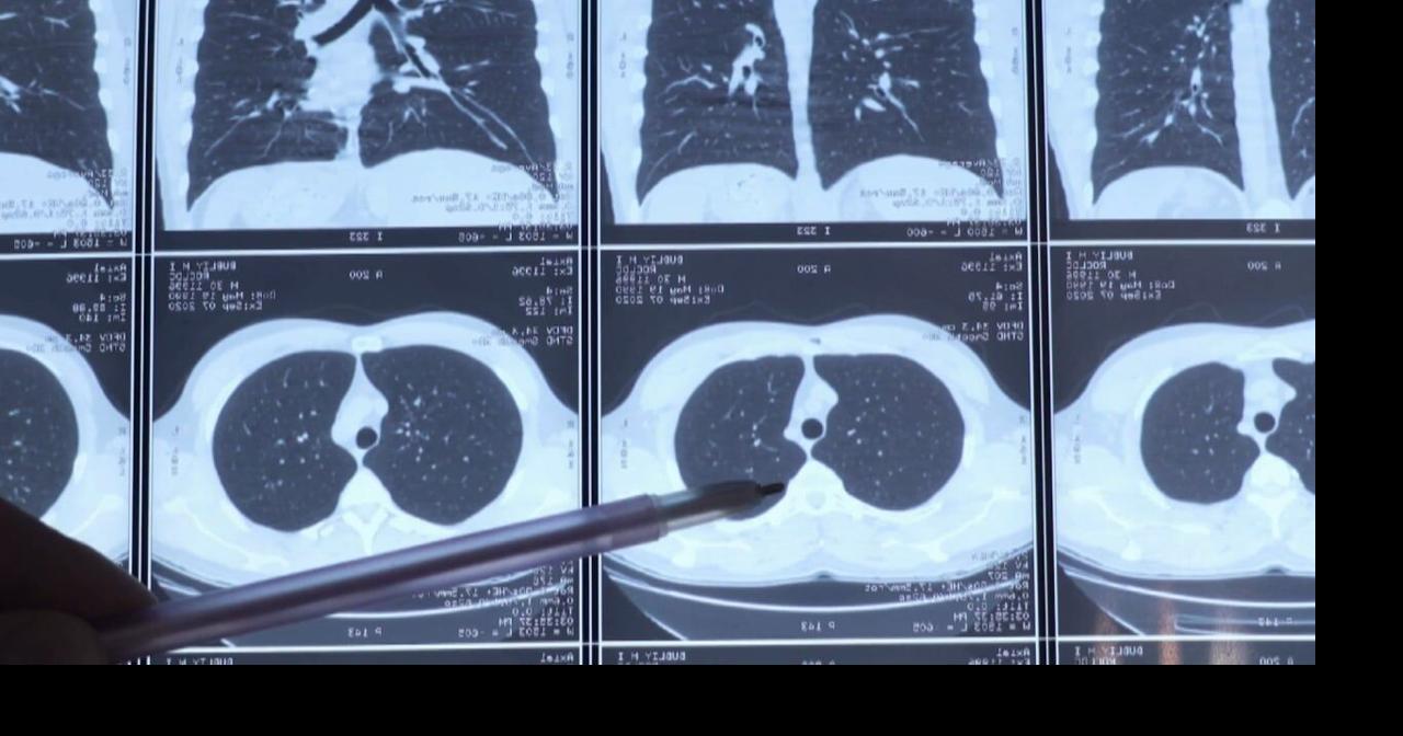 Nuevo robot en Eureka mejora diagnóstico temprano y tratamiento del cáncer de pulmón.