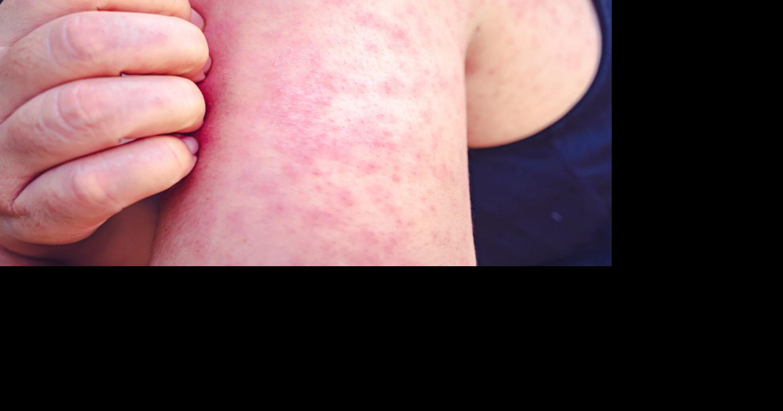 Unvaccinated Kentuckian has measles in first kn…