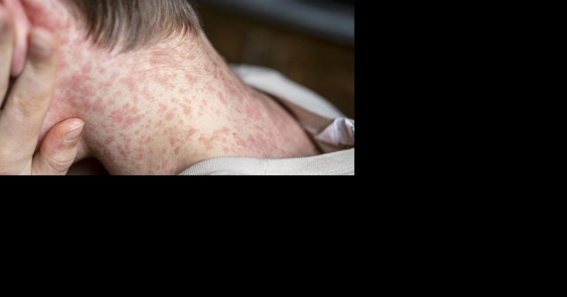 Read More3 measles cases means outbreak in Colter Bay