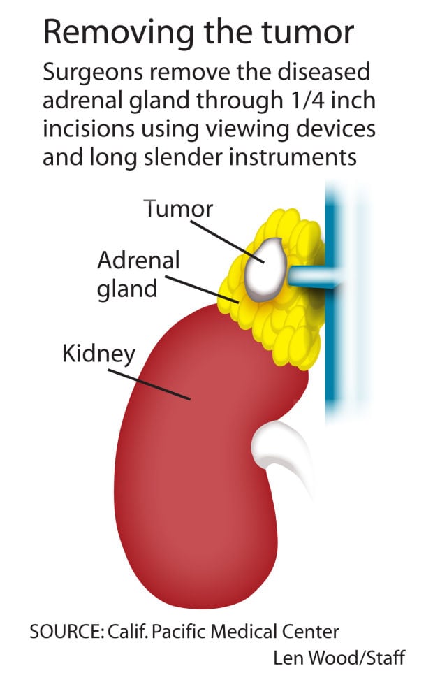 What Is Adrenal Gland Cancer Symptoms at Joseph Russo blog