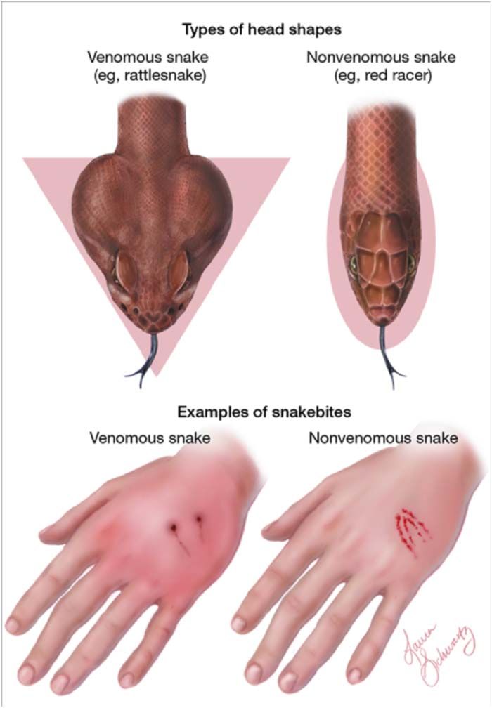 What Do Poisonous Bites Look Like