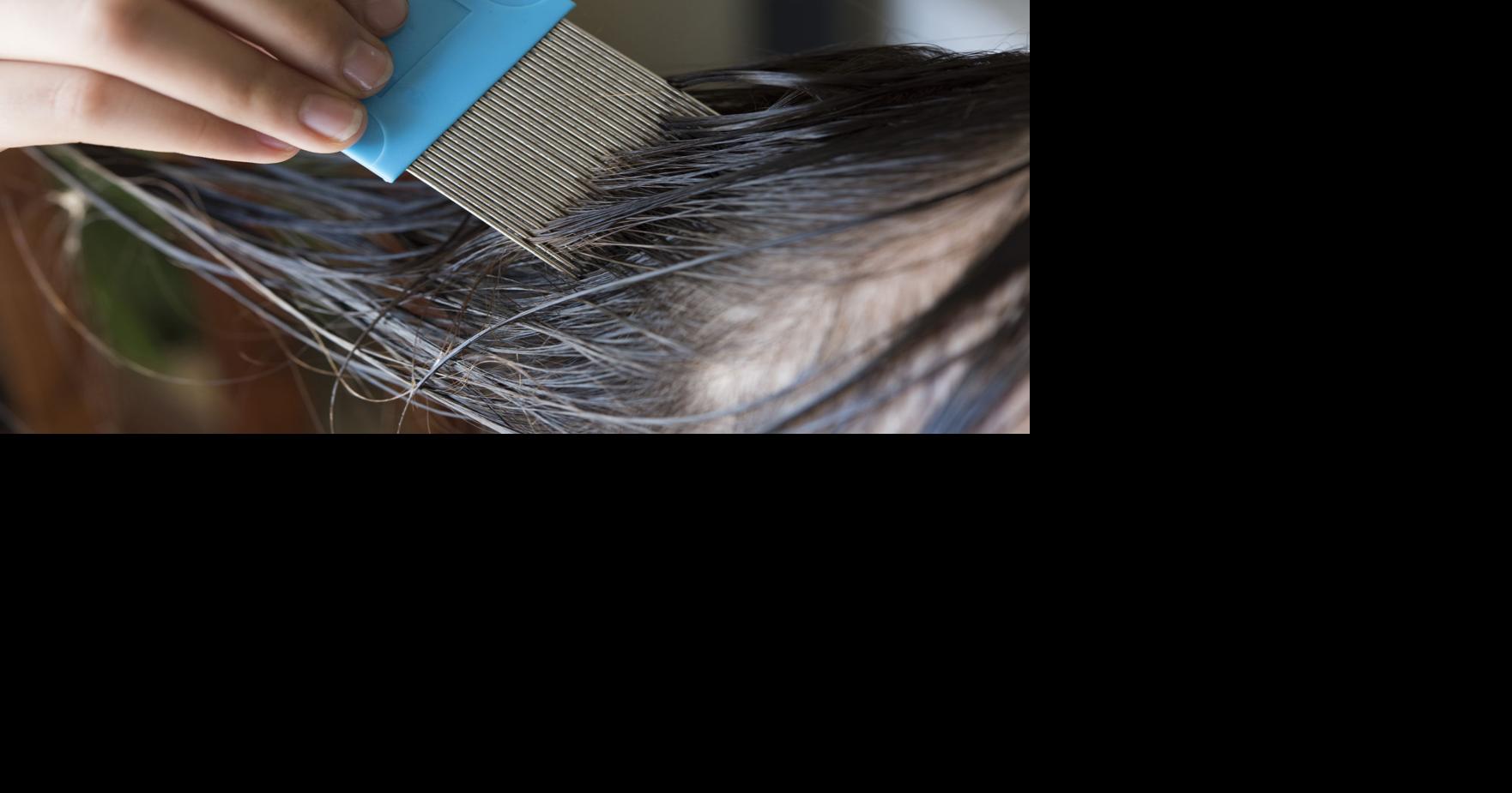 Parents beware: New OTC-resistant lice detected in hair