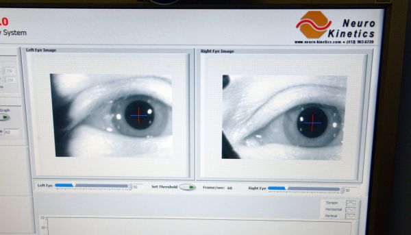 Eye movement test assists in diagnosis of concussion