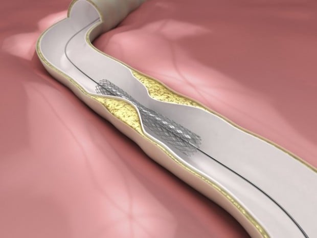 Heart savers: Stents continue to evolve