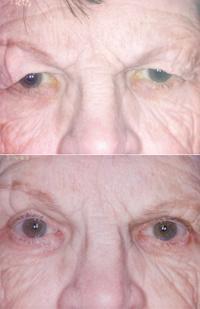 Cataract, eyelid surgical procedures benefit Siouxland patients  