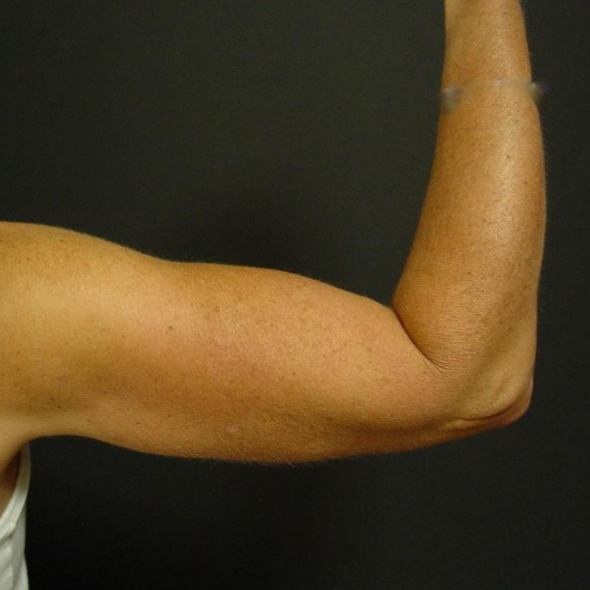 Women Go Under The Knife To Fix Flabby Arms Health Medicine And Fitness Siouxcityjournal Com Women Go Under The Knife To Fix Flabby Arms Health Medicine And Fitness Siouxcityjournal Com