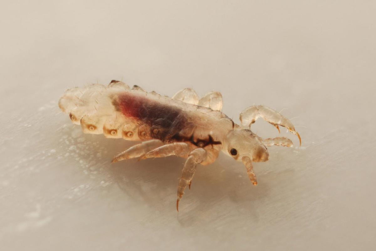 Parents Beware New Otc Resistant Lice Detected In Hair Health