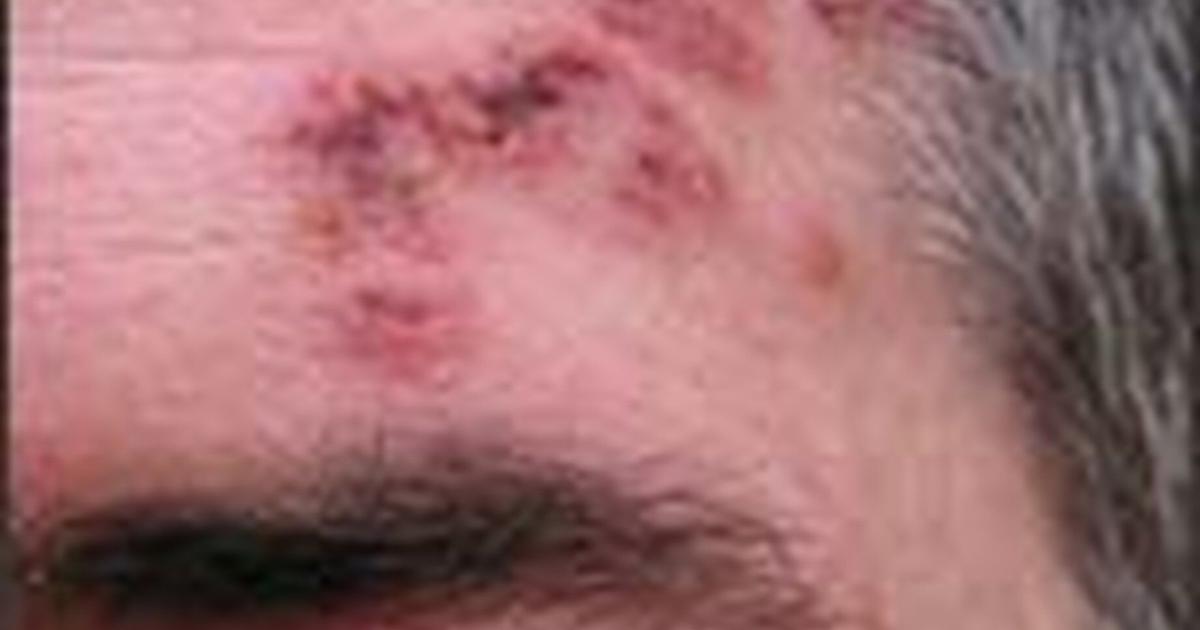 Ginger Rash Springfield Mo Springfield has a shortage of shingle vaccines | | springfieldnewssun.com