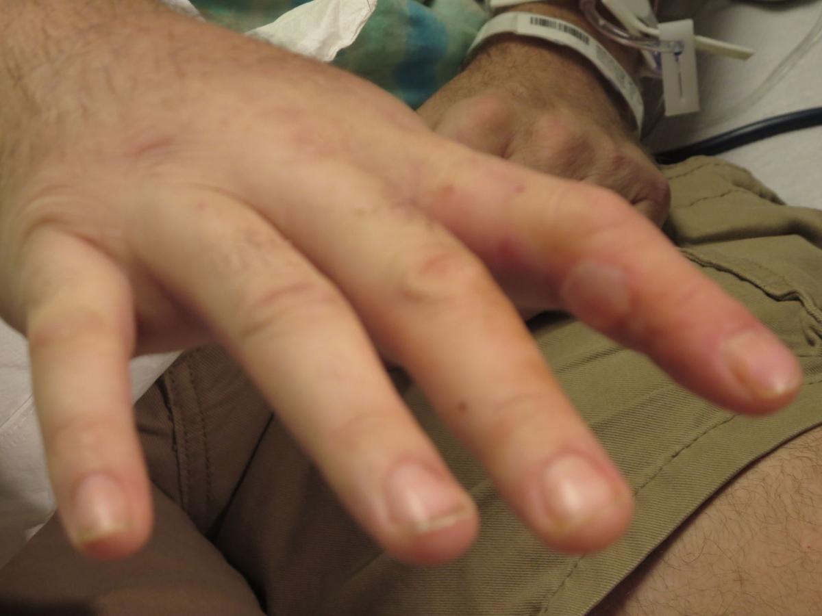 Mckinney Man Survives Yet Another Snake Bite News Starlocalmedia Com Mckinney Man Survives Yet Another Snake Bite News Starlocalmedia Com
