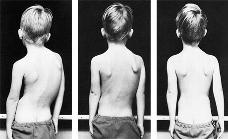 13-year-old ‘Curvy Girl’ launches scoliosis support group; STGnews ...