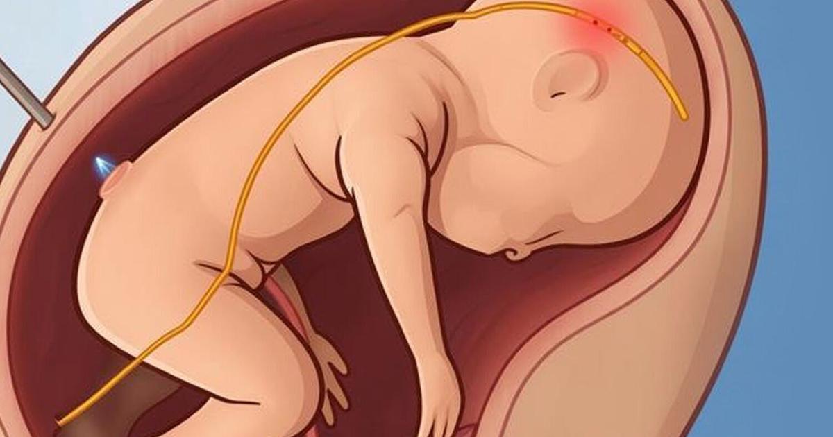 Tiny probe monitors unborn baby’s health inside womb during surgery | Nation Tiny probe monitors unborn baby’s health inside womb during surgery | Nation