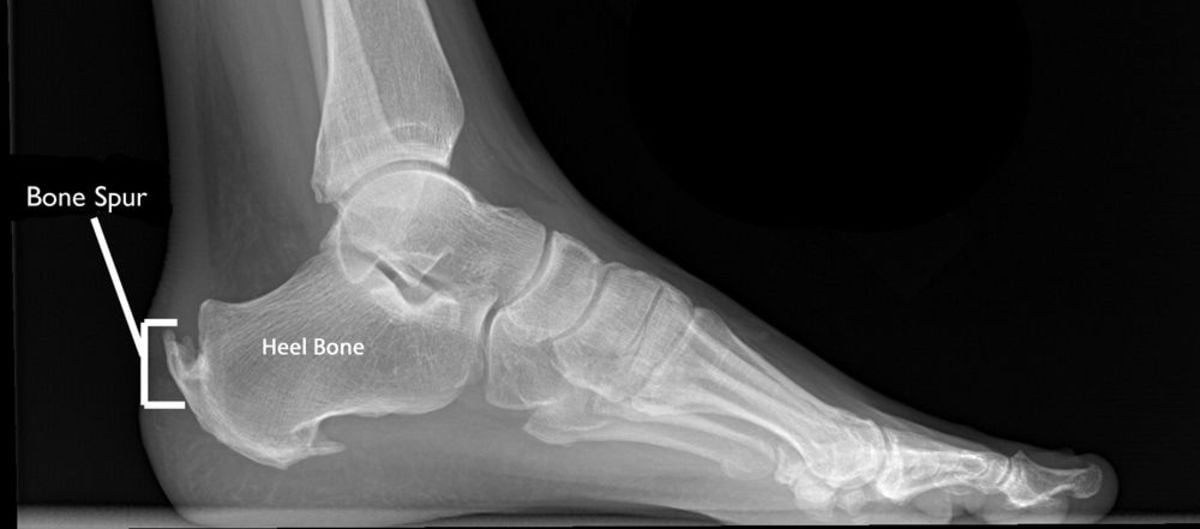 heel bone spur causes