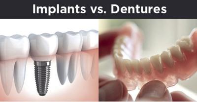 Lose The Dentures Get The Implants Tctimes Com