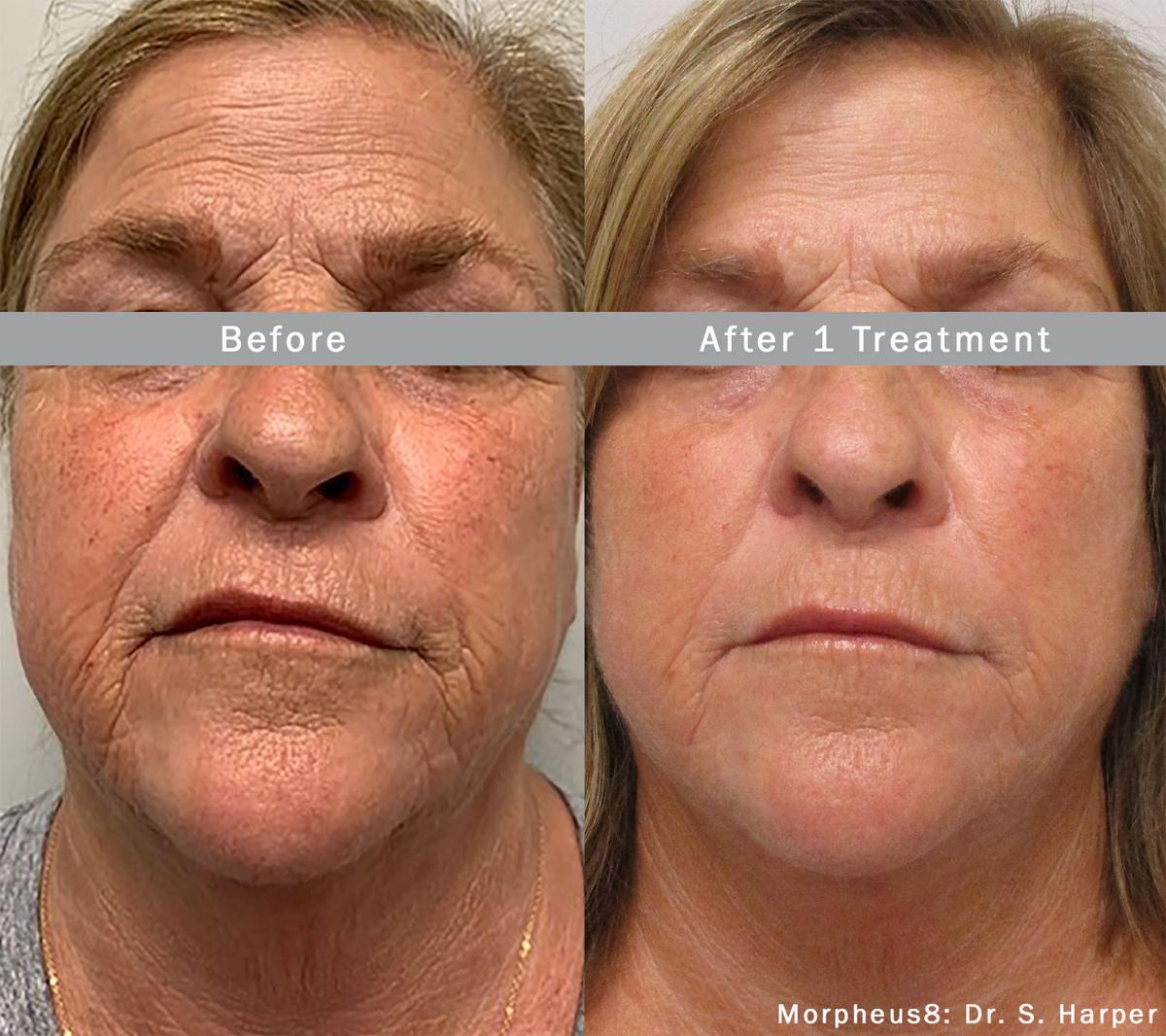 MD Pen Skin Rejuvenation With MicroNeedling on the EC! 