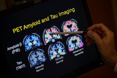 Blood tests for Alzheimer's may be coming to your doctor's office. Here's what to know