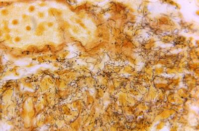 Montreal network to tackle 'explosion' in infections such as syphilis with new trials