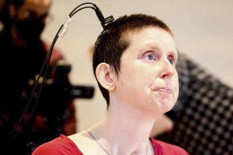 A stroke survivor speaks again with the help of an experimental brain-computer implant