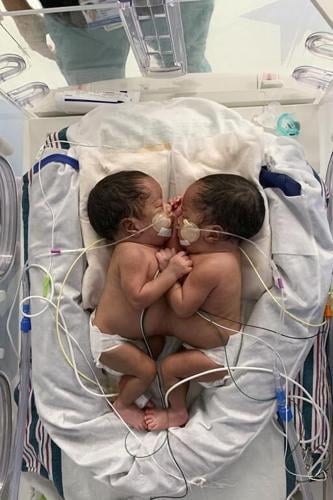 Twins born conjoined celebrate 1st birthday after separation surgery