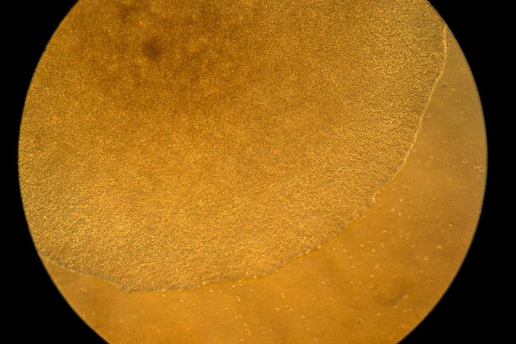 Researchers try bold new approach in a race to better treat autoimmune diseases