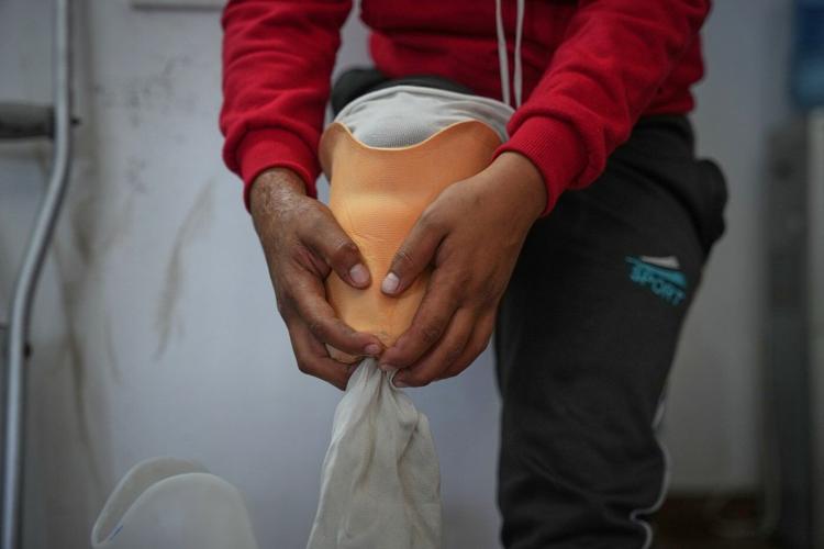 Photos of amputees in Gaza, struggling to survive after losing limbs to Israeli airstrikes