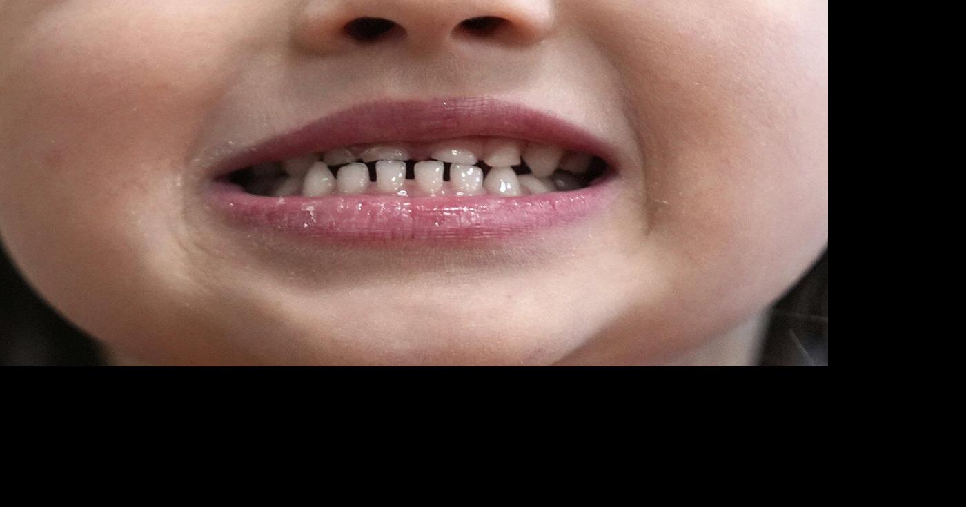 FDA and RFK Jr. aim to remove ingestible fluoride products used to protect kids’ teeth | Health News