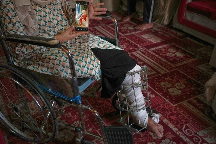 Gaza amputees struggle to rebuild lives as the enclave faces shortages of prosthetic limbs