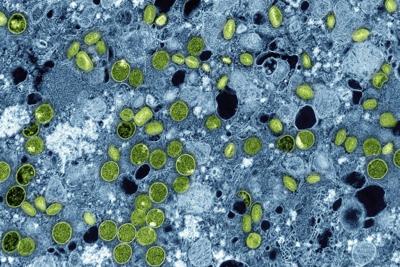 First ɫֱ case of more severe mpox strain confirmed in Manitoba