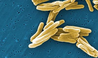 Active case of tuberculosis detected at University of Victoria
