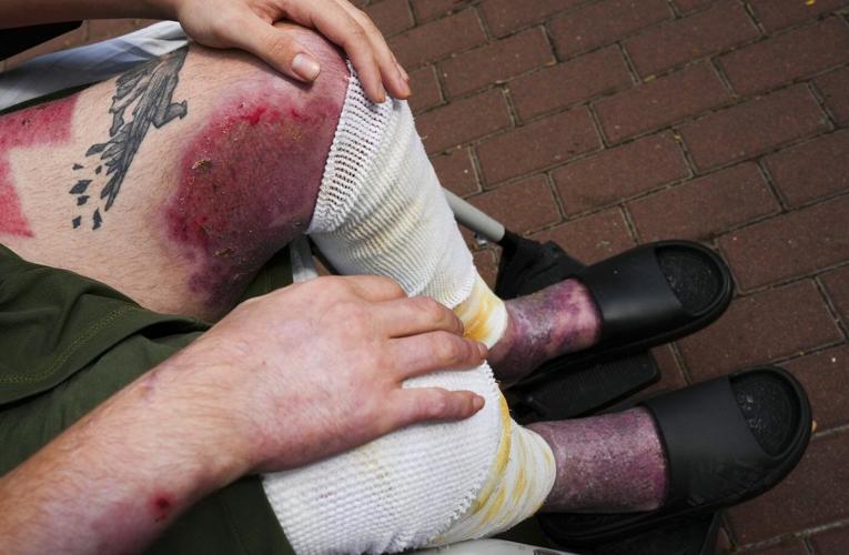 'Just shoot me': Calgarian fighting in Ukraine in painful recovery after drone attack