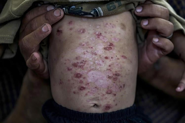 Lice, scabies, rashes plague Palestinian children as skin disease runs rampant in Gaza's tent camps