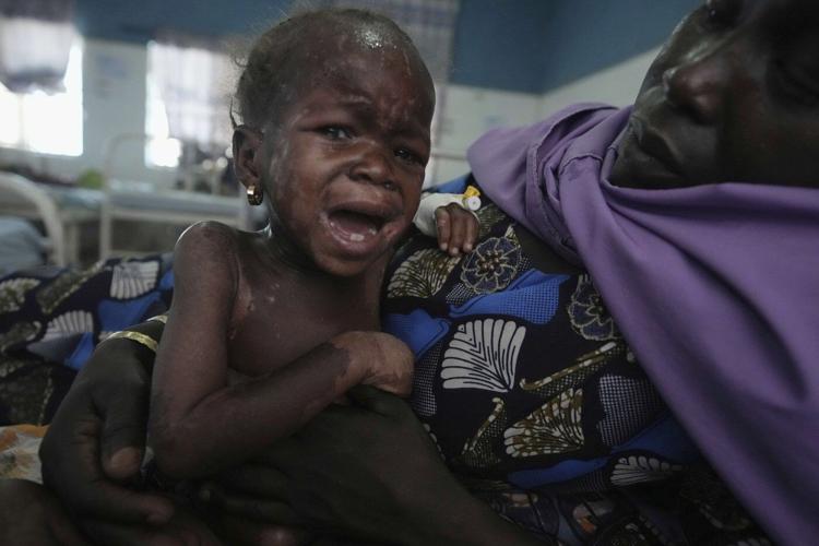 Children die as USAID aid cuts snap a lifeline for the world's most malnourished