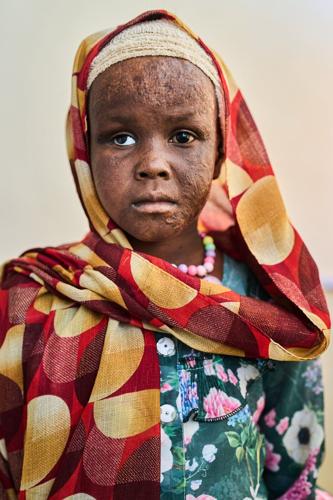The scars of war among survivors in Sudan
