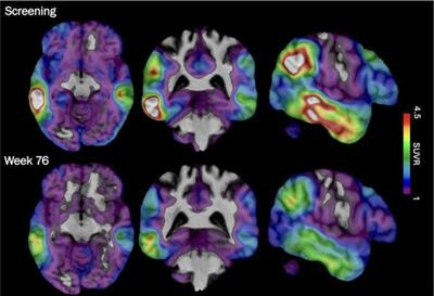 An experimental Alzheimer's drug shows some promise as researchers hunt new approaches