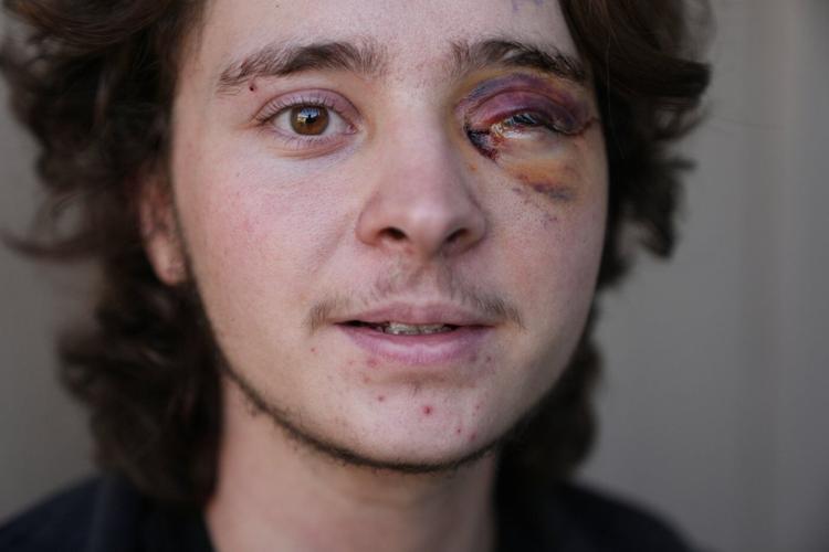 California protester left blind in one eye is among string of violent run-ins with federal agents